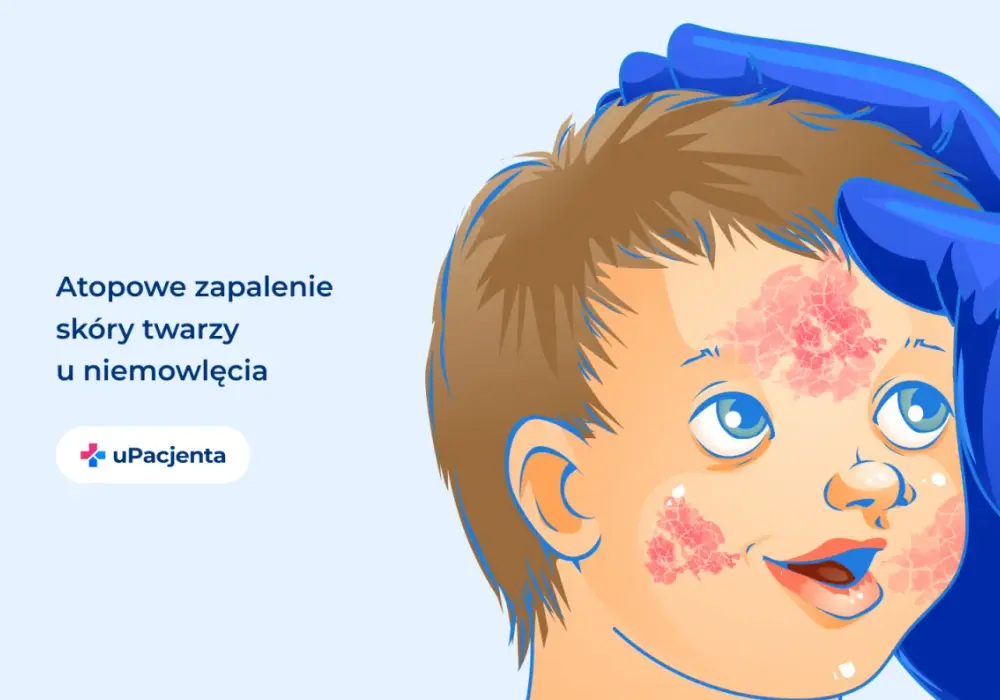 AZS na twarzy - Jak rozpoznać i skutecznie pielęgnować?