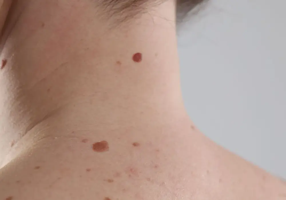 Pieprzyki i znamiona - Kiedy do dermatologa?