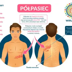 Półpasiec to bolesna wysypka podobna do półpaśca, wywołana przez wirus VZV. Objawia się jako pas pęcherzy, często na tułowiu.