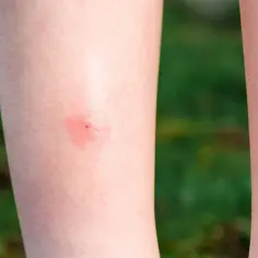 Czerwony rumień po meszce na skórze nogi, widoczny punkt ukłucia.