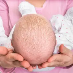 Główka niemowlaka z objawami rybiej łuski choroby. Skóra jest sucha, łuszcząca się, tworząc charakterystyczne łuski.
