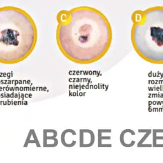 ABCDE - kluczowe cechy czerniaka: asymetria, brzegi, kolor, duży rozmiar, ewolucja. Poznaj objawy czerniaka.