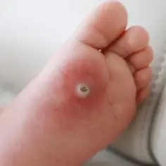 Dziecko ma kurzajkę na stopie, która jest widoczna jako okrągła zmiana skórna z ciemnym środkiem.