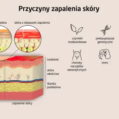 Ilustracja porównuje zdrową skórę z zapaleniem skóry, pokazując jego przyczyny: czynniki środowiskowe, genetykę, infekcje, choroby wewnętrzne, stres i kontakt z drażniącymi substancjami.