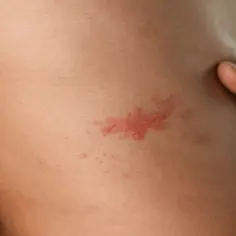 Skóra z czerwonymi, pęcherzykowymi zmianami, które pokazują, jak wygląda liszaj. Dłoń dotyka boku ciała.