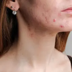 Skóra z widocznym trądzikiem na policzku i szyi. Rozważenie antybiotyku na trądzik może być rozwiązaniem.