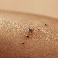Zbliżenie na skórę z kilkoma ciemnymi znamionami, jedno z nich jest lekko wypukłe.