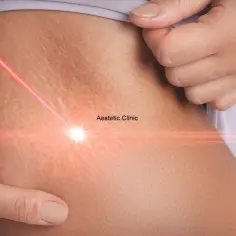 Zbliżenie na skórę z rozstępami, na którą skierowany jest czerwony promień lasera.