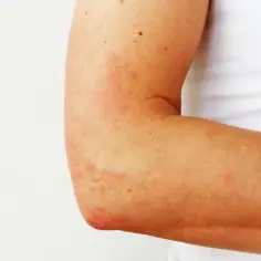 Ramię z zaczerwienioną, swędzącą skórą, objawy fotodermatozy.