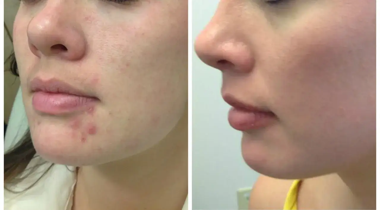 Przed i po leczeniu trądziku. Po lewej widoczne zmiany zapalne, po prawej gładka skóra. Czy to efekt Accutane?