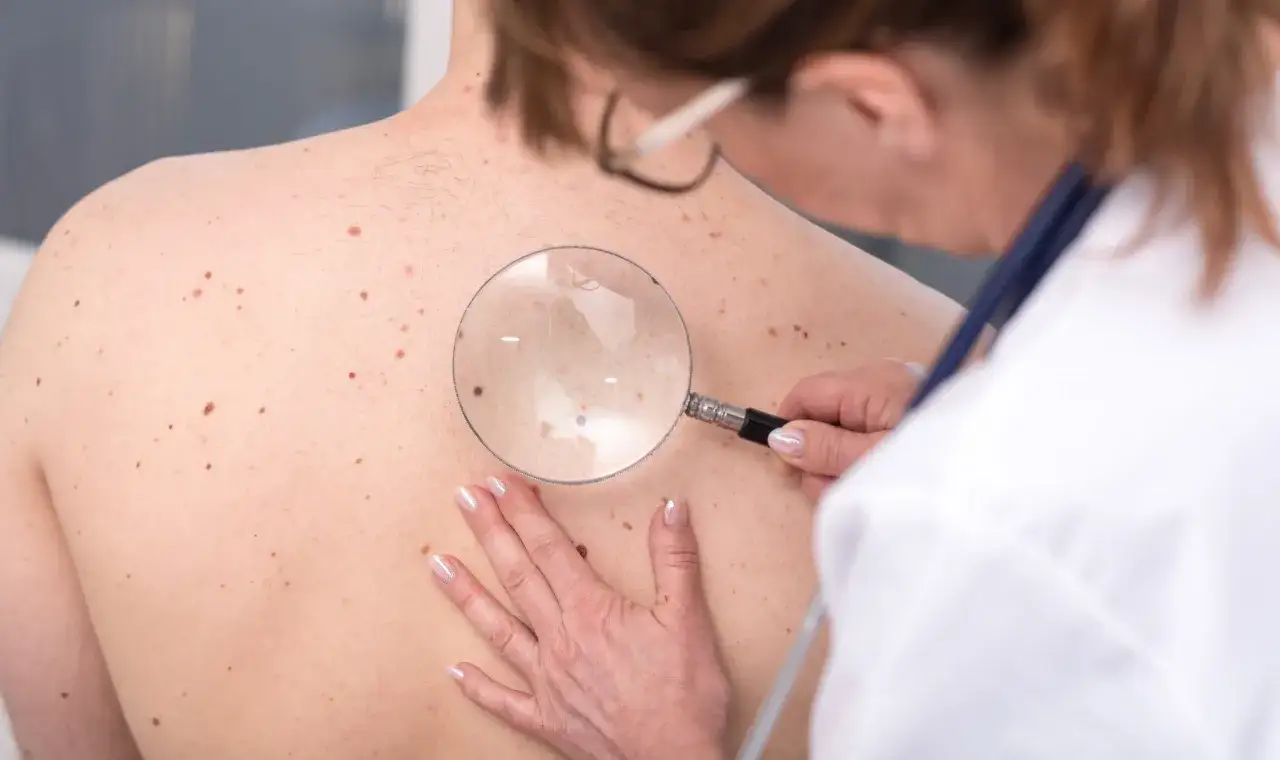 Dermatolog bada liczne znamiona barwnikowe na plecach pacjenta za pomocą lupy.