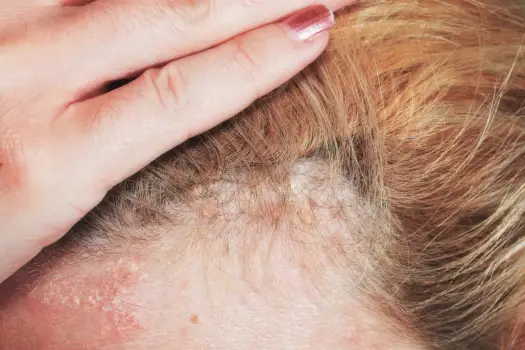 Strupy na głowie - skąd się biorą i kiedy iść do dermatologa