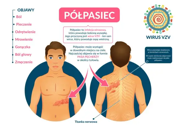 Półpasiec czy inna wysypka? Jak rozpoznać i co robić?