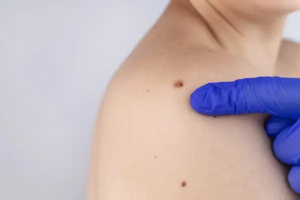 Pieprzyki rakowe - Jak rozpoznać i kiedy iść do lekarza?
