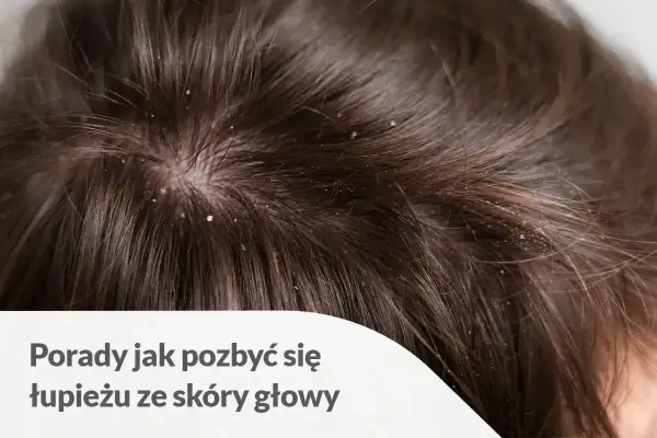 Cyklopiroks - Twój lek na łupież? Kiedy działa, jak stosować?