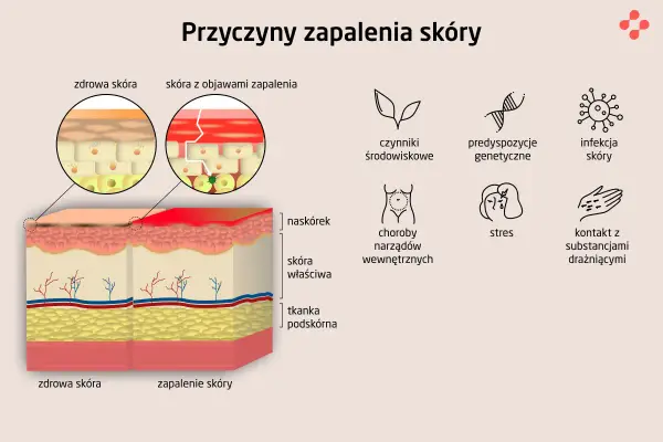 Zapalenie skóry - Jak pielęgnować i kiedy iść do lekarza?
