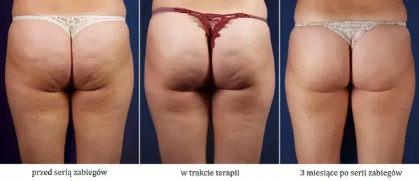 Jakie zioła na cellulit skutecznie redukują widoczność pomarańczowej skórki